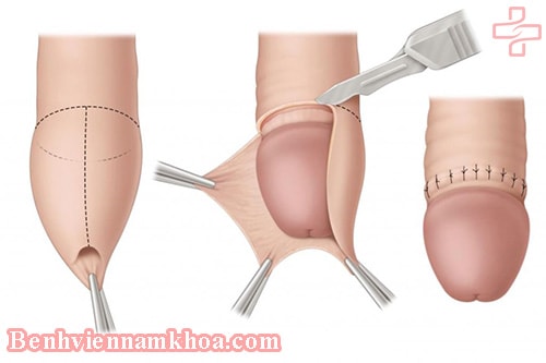 Cắt bao quy đầu và những điều bạn cần biết