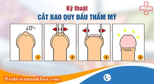 Cắt bao quy đầu thẩm mỹ