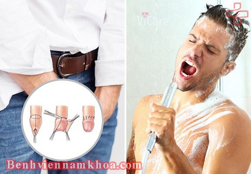 Cắt bao quy đầu xong bị phù nề