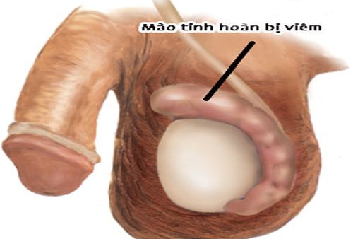 Viêm mào tinh hoàn uống thuốc gì?