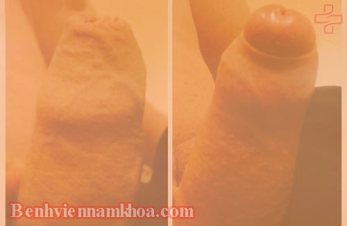 Hình ảnh hẹp bao quy đầu