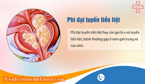 Phì đại tuyến tiền liệt là gì?