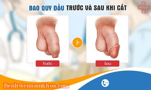 Tại sao phải cắt bao quy đầu?