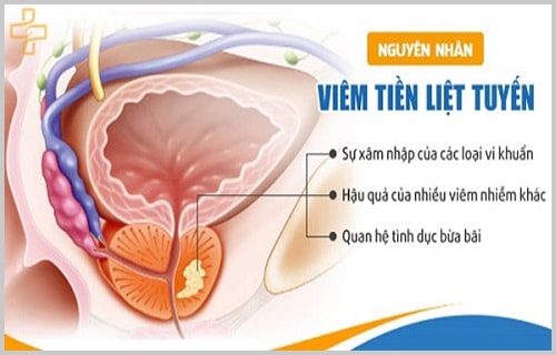 Bệnh viêm tuyến tiền liệt ở nam giới