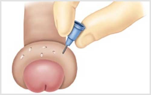 Bị sưng bao quy đầu
