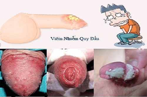 Ngứa bao quy đầu