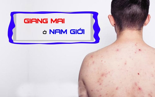 Dài bao quy đầu giả có cần chữa không?