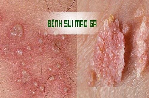 Tổng quan về bệnh sùi mào gà