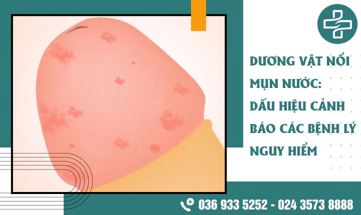 Dương vật nổi mụn nước nguyên nhân do đâu? 1 số cách điều trị hiệu quả