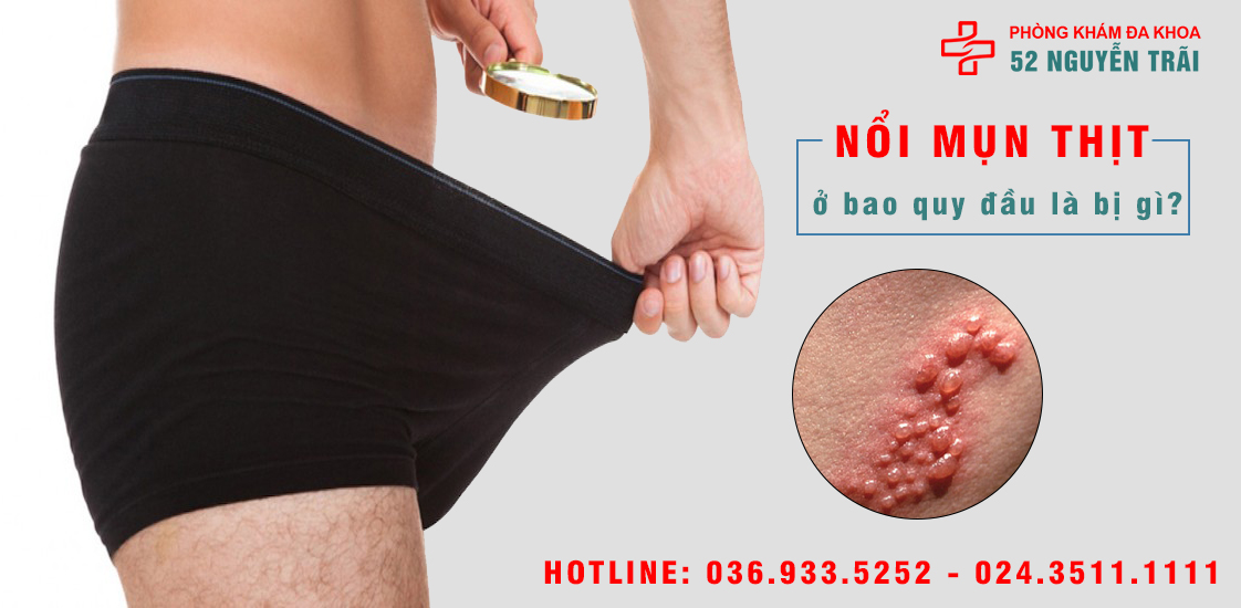 NỔI MỤN THỊT Ở BAO QUY ĐẦU LÀ BỊ BỆNH GÌ?