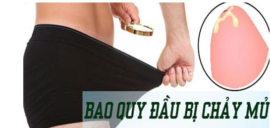 Bao quy đầu có mủ – Nam giới tuyệt đối không được chủ quan