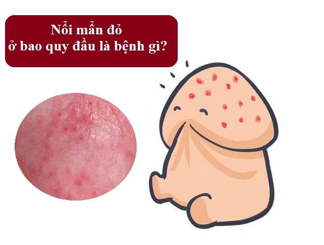 Bao quy đầu nổi mẩn đỏ, ngứa – Nam giới không được chủ quan
