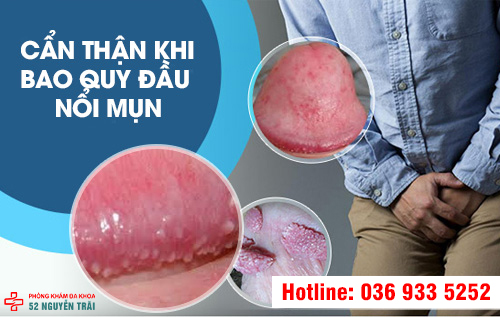 Bao quy đầu nổi mụn đỏ là sao? Nam giới không nên chủ quan với nguyên nhân gây ra