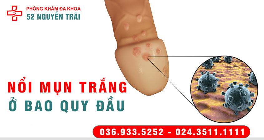 MỤN TRẮNG Ở BAO QUY ĐẦU CẢNH BÁO BỆNH GÌ
