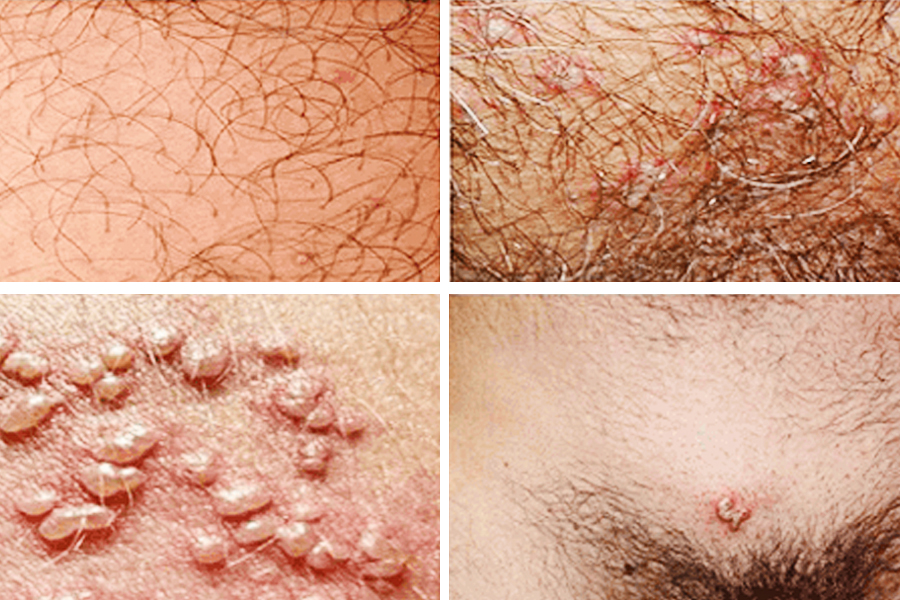 Phòng khám chữa herpes sinh dục uy tín