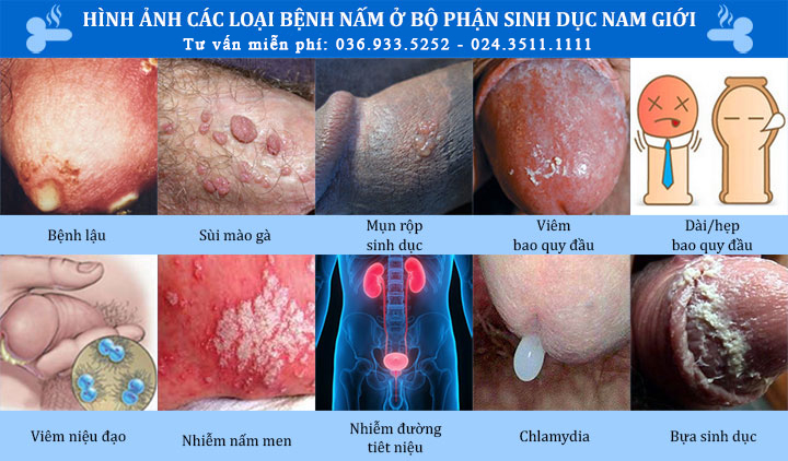 Các loại bệnh nấm ở bộ phận sinh dục nam giới & Cách chữa hiệu quả