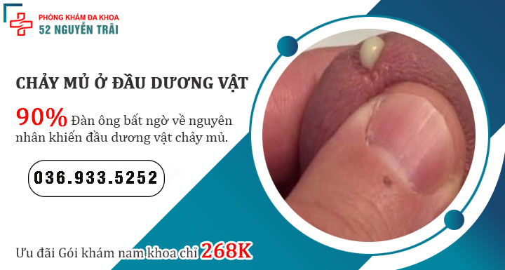 90% Đàn ông bất ngờ về nguyên nhân khiến đầu dương vật chảy mủ